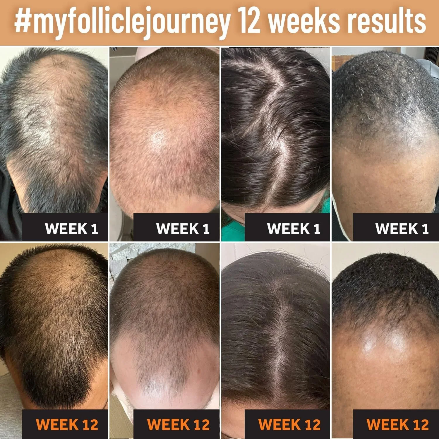 Follixil 5% Minox - Lotion - Image 3